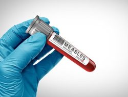 Banten Siaga Campak: 4.456 Suspek Terdeteksi, 6 Pasien Meninggal Dunia